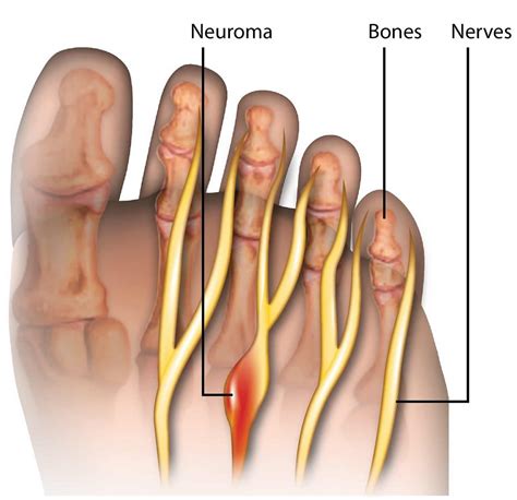 morton's neuroma prognosis